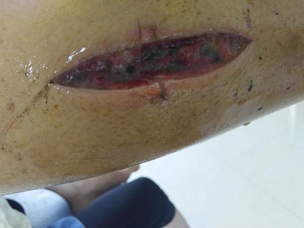 Kirurška rana od petnaest centimetara koju je pretrpjela autorica nakon što ju je ugrizla otrovna zmija. 